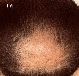 5% Minoxidil Kirkland для роста волос и бороды (3 флакона + дозатор)