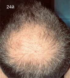 5% Minoxidil Kirkland для росту волосся та бороди (3 флакона + дозатор) фото від покупців 18