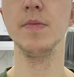 Піна minoxidil 5% KIRKLAND (2 флакони) фото от покупателей 1