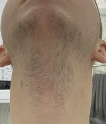 Піна minoxidil 5% KIRKLAND (2 флакони)