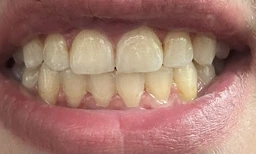 Корректор цвета зубов SmileKit V34 30 мл (405541) фото от покупателей 1