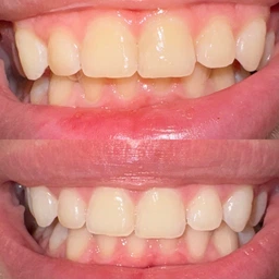 Отбеливающие полоски Crest 1/2 упаковки Glamorous Whitestrips 7 упаковок, 14 полосок / Пробный курс для чувствительных зубов