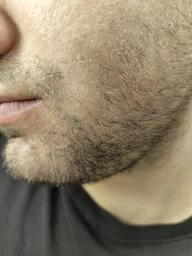 Миноксидил 5% Kirkland Minoxidil для роста бороды и волос 60ml, 6 штук фото от покупателей 7
