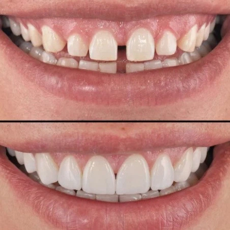Винири зубние Perfect Smile Veneers сменние White (kz059) - изображение 4