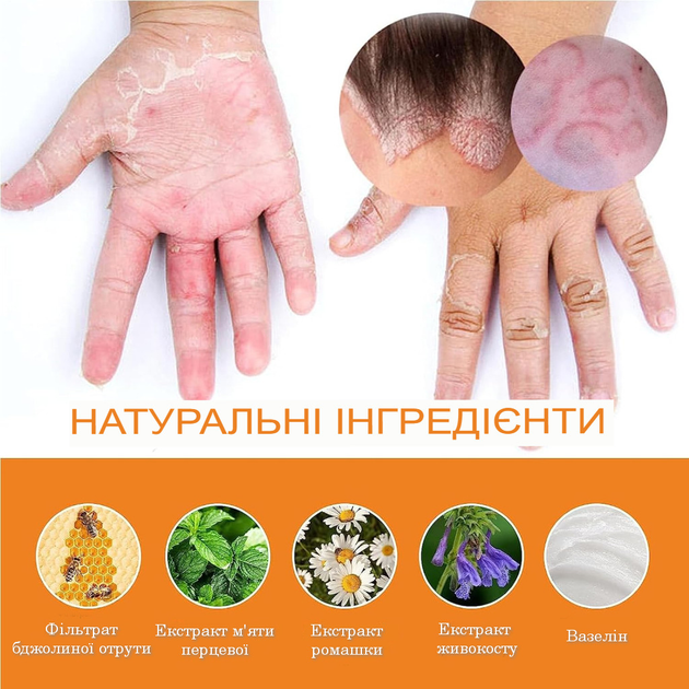 Крем для лікування псоріазу з бджолиною отрутою South Moon Bee Venom Psoriasis - изображение 2