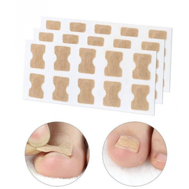 Наклейки тейпы от Врастания Ногтя при деформации ногтевой пластины набор пластырей 50 шт (NST)2ф - изображение 2