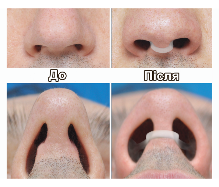 Назальний розширювач антихрап Sleepease Nasal Dilator - зображення 4