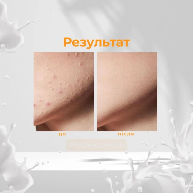 Молочный пилинг Home-Peel 30% рН 3.8 10 мл (4820208890052) - Фото 7 Молочный пилинг Home-Peel 30% рН 3.8 10 мл (4820208890052) - изображение 7