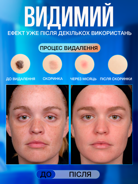 Электрокоагулятор плазменный косметологический прибор профессиональный для удаления родинок папиллом бородавок тату веснушек пигментных пятен аппарат электро коагулятор VLVEE для салона и дома (VLV-5163) - изображение 3