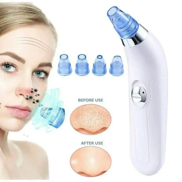 Вакуумний очищувач Derma suction DS Vacuum для професійного чищення шкіри та пор обличчя - легкий компактний зручний прилад у використанні + 4 насадки, Білий - Фото 3 Вакуумний очищувач Derma suction DS Vacuum для професійного чищення шкіри та пор обличчя - легкий компактний зручний прилад у використанні + 4 насадки, Білий - зображення 3