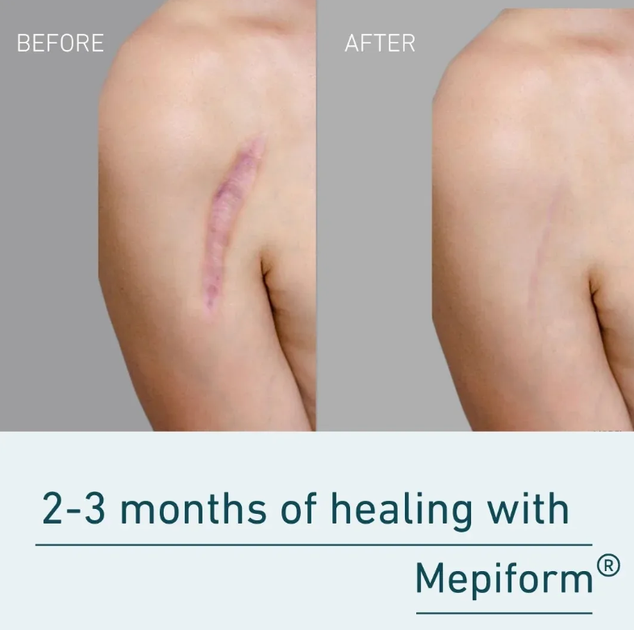 Силиконовый пластырь Мепиформ Mepiform 10x18 см 1 шт для лечения гипертрофических и келоидных рубцов - изображение 5