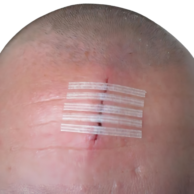 Пластирные полоски Steri-Strip™ 3M 6 мм х 100 мм (R1546) - изображение 8