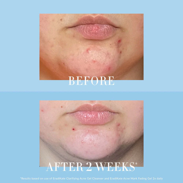 Гель для обличчя Kate Somerville EradiKate Acne Mark Fading 30 мл (810023370543) - зображення 5