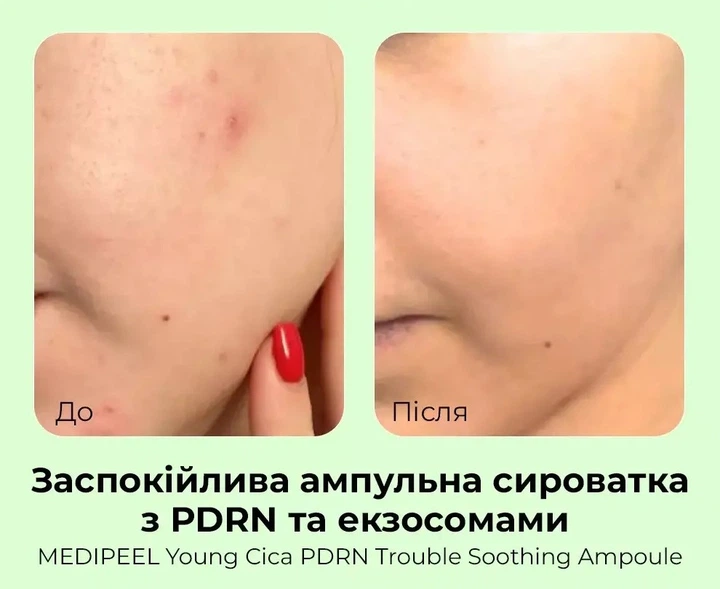 Ампульная сыворотка MEDIPEEL Young Cica PDRN Trouble Soothing Ampoule с центеллой и PDRN 50 мл (8809941824308) - Фото 3 Ампульная сыворотка MEDIPEEL Young Cica PDRN Trouble Soothing Ampoule с центеллой и PDRN 50 мл (8809941824308) - изображение 3
