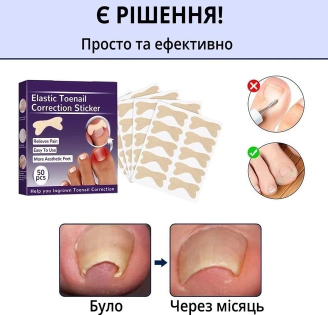Набор пластырей Elastic Toenail Correction Sticker для коррекции и устранения вросших ногтей (50 шт.) - изображение 3