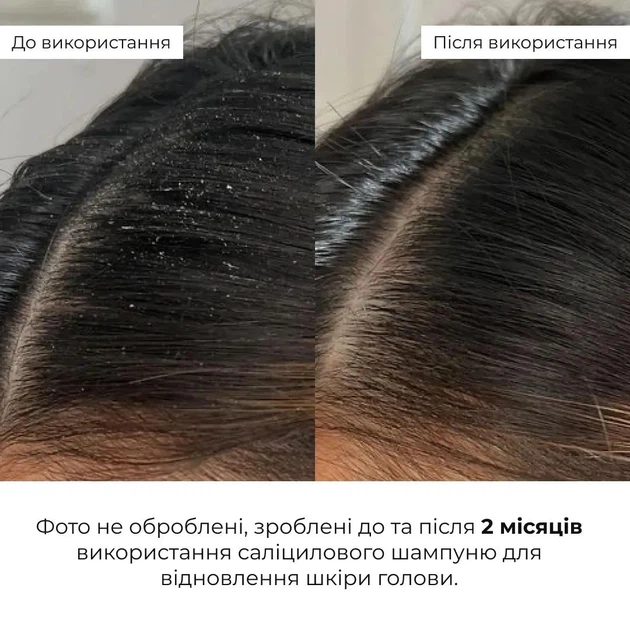 Комплект для глубокой очистки и восстановления волос и кожи головы Шампунь, Кондиционер, Пилинг Hillary Deep Cleanse & Hair Restoration Set K-11-998 - Фото 2 Комплект для глубокой очистки и восстановления волос и кожи головы Шампунь, Кондиционер, Пилинг Hillary Deep Cleanse & Hair Restoration Set K-11-998 - изображение 2