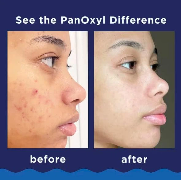 Panoxyl Acne Foaming wash Acne 10% Пінка для вмивання від акне 28 г –  купити онлайн на ROZETKA