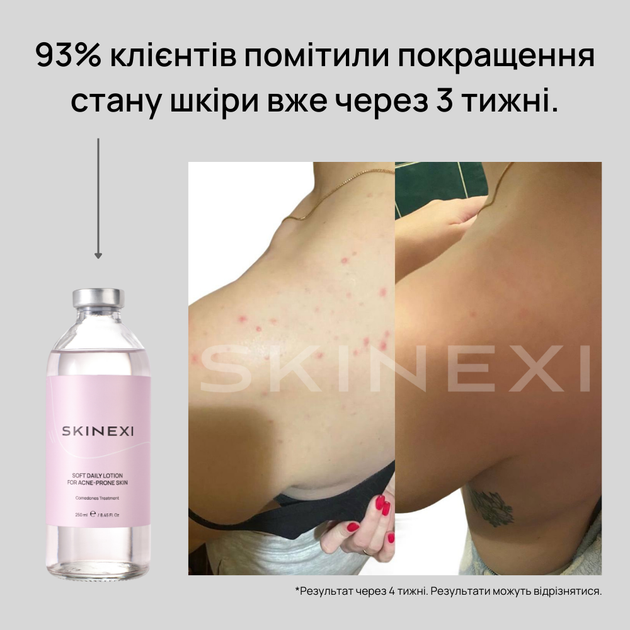Лосьйон для проблемної шкіри від комедонів та чорних цяток Skinexi Soft Daily Lotion 250 мл - Фото 3 Лосьйон для проблемної шкіри від комедонів та чорних цяток Skinexi Soft Daily Lotion 250 мл - зображення 3