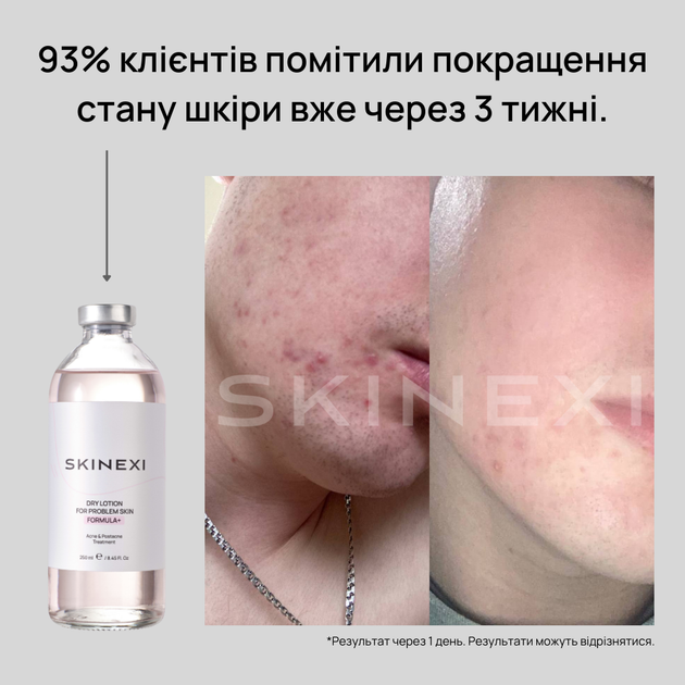 Лосьон для проблемной кожи от прыщей и акне Skinexi Dry Lotion Formula+ 250 мл - Фото 5 Лосьон для проблемной кожи от прыщей и акне Skinexi Dry Lotion Formula+ 250 мл - изображение 5