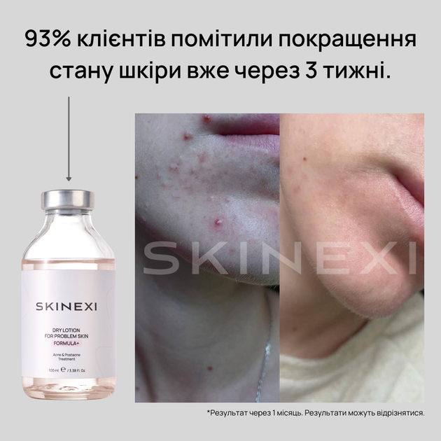 Лосьйон для проблемної шкіри від прищів та акне Skinexi Dry Lotion Formula+ 100 мл - Фото 4 Лосьйон для проблемної шкіри від прищів та акне Skinexi Dry Lotion Formula+ 100 мл - зображення 4