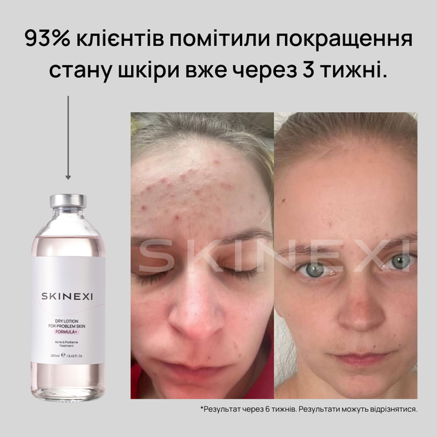 Лосьон для проблемной кожи от прыщей и акне Skinexi Dry Lotion Formula+ 250 мл - Фото 6 Лосьон для проблемной кожи от прыщей и акне Skinexi Dry Lotion Formula+ 250 мл - изображение 6