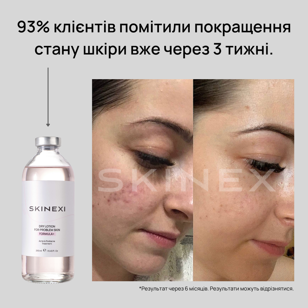 Лосьон для проблемной кожи от прыщей и акне Skinexi Dry Lotion Formula+ 250 мл - Фото 8 Лосьон для проблемной кожи от прыщей и акне Skinexi Dry Lotion Formula+ 250 мл - изображение 8