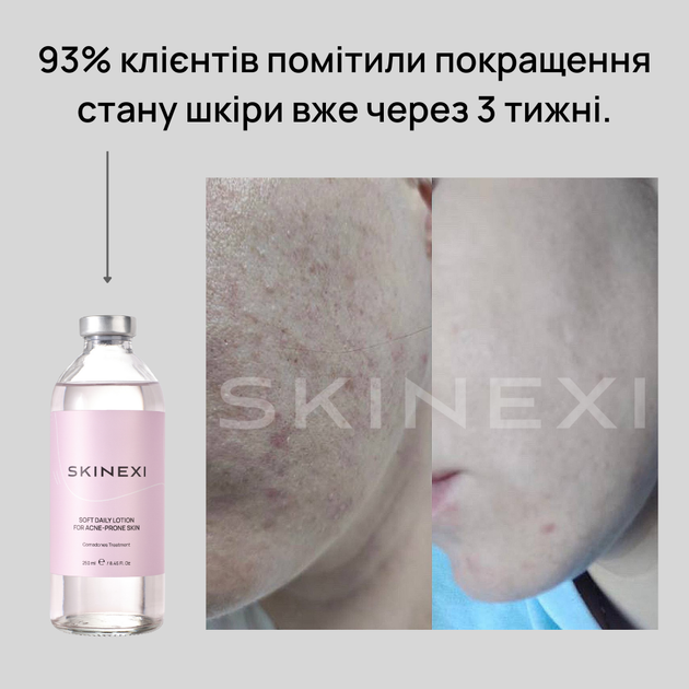 Лосьйон для проблемної шкіри від комедонів та чорних цяток Skinexi Soft Daily Lotion 250 мл - Фото 7 Лосьйон для проблемної шкіри від комедонів та чорних цяток Skinexi Soft Daily Lotion 250 мл - зображення 7