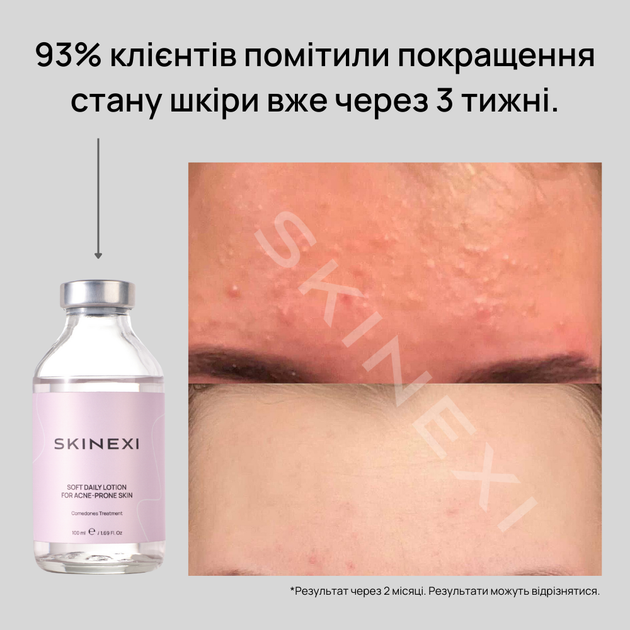 Лосьйон для проблемної шкіри від комедонів та чорних цяток Skinexi Soft Daily Lotion 100 мл - Фото 8 Лосьйон для проблемної шкіри від комедонів та чорних цяток Skinexi Soft Daily Lotion 100 мл - зображення 8
