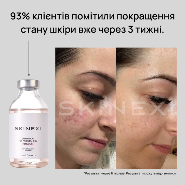 Лосьйон для проблемної шкіри від прищів та акне Skinexi Dry Lotion Formula+ 100 мл - Фото 8 Лосьйон для проблемної шкіри від прищів та акне Skinexi Dry Lotion Formula+ 100 мл - зображення 8