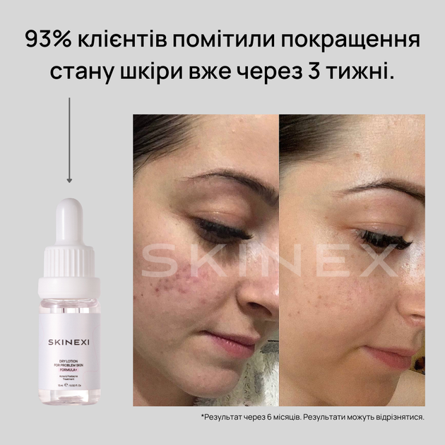 Лосьон для проблемной кожи от прыщей и акне Skinexi Dry Lotion Formula+ 15 мл - Фото 8 Лосьон для проблемной кожи от прыщей и акне Skinexi Dry Lotion Formula+ 15 мл - изображение 8