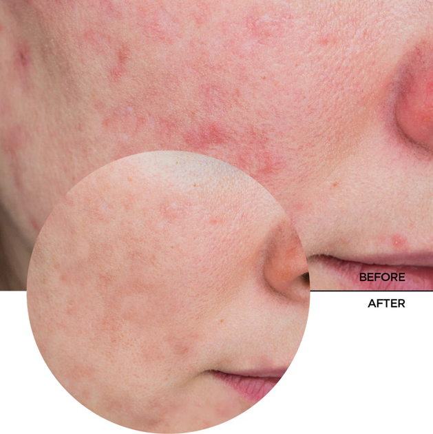 Крем для обличчя Revox B77 Just Azelaic Acid 10% освітлювальний 30 мл (5060565102835) - зображення 3