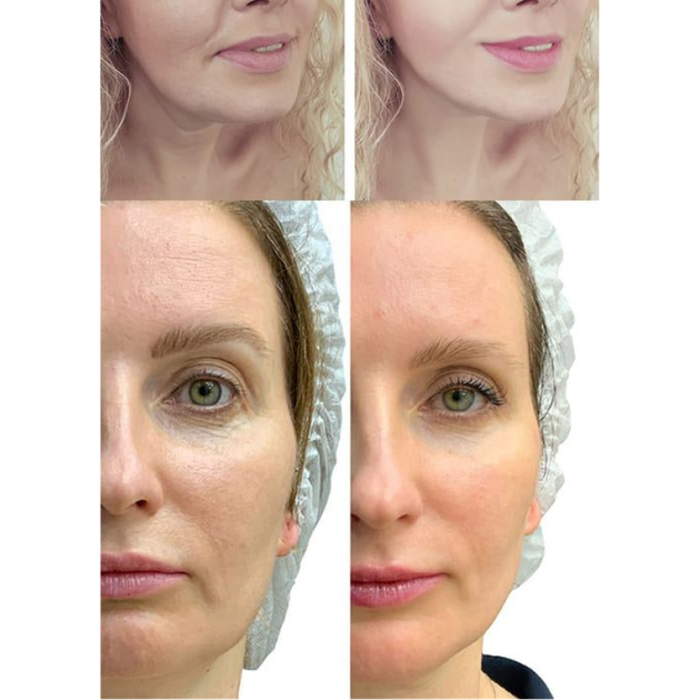 Микрострумовый лифтинг-массажер для лица MEDICA+ Skin Lifting 7.0 White (EMS, LED) - изображение 8