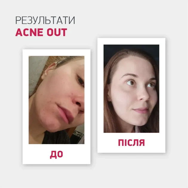 Biotrade (Біотрейд) Acne Out SPF30 – відновлювальний крем для обличчя зі шкірою з видимими дефектами та плямами постакне, 30 мл - Фото 3 Biotrade (Біотрейд) Acne Out SPF30 – відновлювальний крем для обличчя зі шкірою з видимими дефектами та плямами постакне, 30 мл - изображение 3
