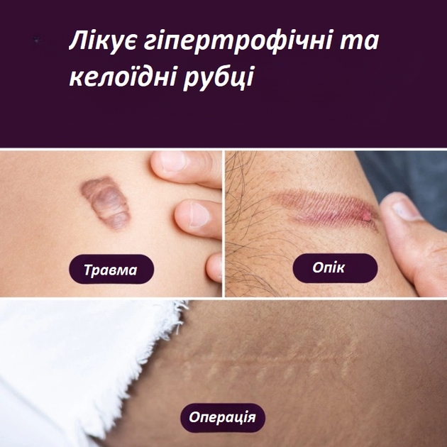 Пластирі для корекції шрамів Mederma Silicone Small 4 штуки 3,5 х 7,6 см - зображення 7