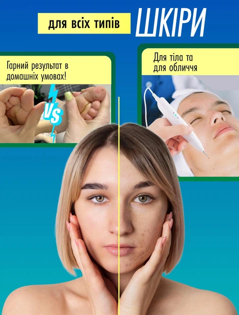 Электрокоагулятор плазменный косметологический прибор коагулятор для удаления родинок папиллом бородавок тату веснушек пигментных пятен элетро плазменная ручка Mini Freckle многофункциональный аппарат безболезненное коагулирование тканей - изображение 6