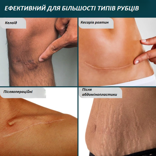 Набір для догляду за рубцями Nuvadermis Silicone Scar Tape & Overnight Intensive Scar Cream Duo (крем 40 мл і пластир 4 см × 300 см) - зображення 9
