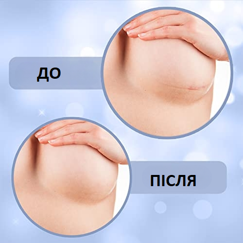 Силиконовые пластыри против шрамов Miztag Home & Health для реабилитации после пластики груди 4 пары - изображение 6
