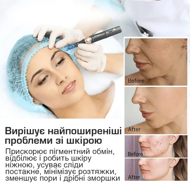 Dr. Pen Ultima A8S — профессиональное дермапен-устройство с батарейкой для фракционной мезотерапии, микронидлинга лица и тела - изображение 9