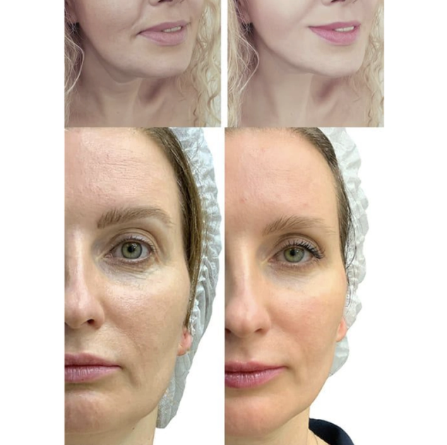 Микротоковый RF лифтинг массажер для лица MEDICA+ Skin Lifting 7.0 White EMS LED - изображение 7