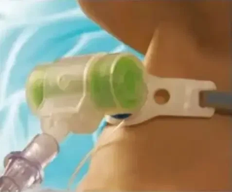 Фильтр дыхательный вирусо-бактериальный Hydro-Trach II Intersurgical с тепло-влагообменником (искусственный нос) для трахеостомы - Фото 2 Фильтр дыхательный вирусо-бактериальный Hydro-Trach II Intersurgical с тепло-влагообменником (искусственный нос) для трахеостомы - изображение 2