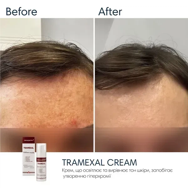 Освітлювальний крем BRADERM Tramexal Cream, 30 мл 00-00000388 - зображення 3