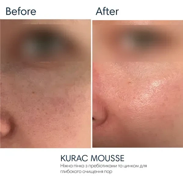 Деликатная пенка для умывания BRADERM Kurac Mousse, 100 мл 00-00000384 - изображение 3