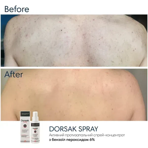 Протизапальний спрей-емульсія BRADERM Dorsak Spray, 100 мл 00-00000385 - зображення 4