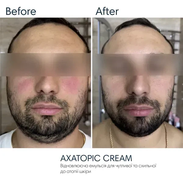 Увлажняющая эмульсия BRADERM Axatopic Cream, 250 мл 00-00000427 - Фото 2 Увлажняющая эмульсия BRADERM Axatopic Cream, 250 мл 00-00000427 - изображение 2