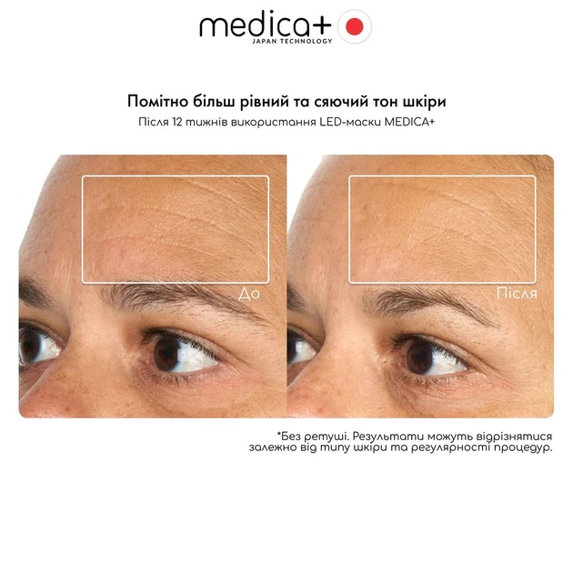 Led-маска Medica+ LEDMask 8X для светотерапии, 7 режимов, гибкий силикон - изображение 4