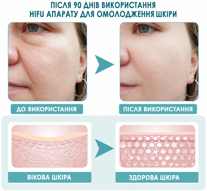 Прибор для RF-лифтинга, омоложения и подтяжки кожи лица UPG Magic Mini HIFU 2.0 - изображение 8