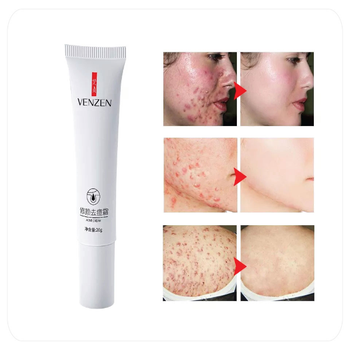 Крем от акне и прыщей Venzen anti acne точечный с никотинамидом для проблемной кожи 20 г