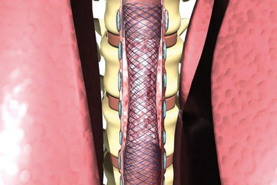 Трахеальний стент без покриття MICRO-TECH