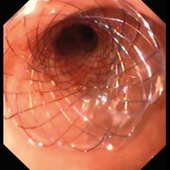 Дуоденальний стент MICRO-TECH Double Spherical з покриттям