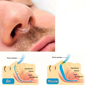 Назальний розширювач антихрап Sleepease Nasal Dilator